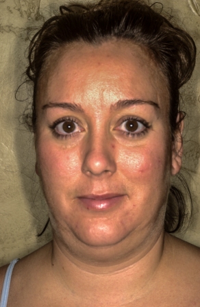 Submental liposuction 3 preop Submental liposuction 3 preop