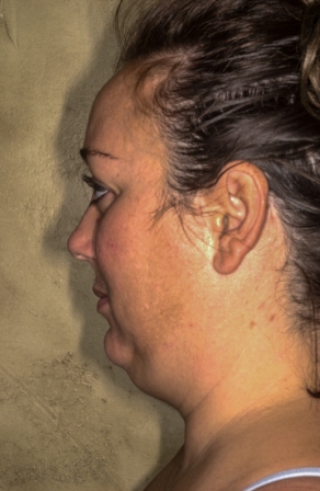 submental liposuction 3 preop lateral submental liposuction 3 preop lateral