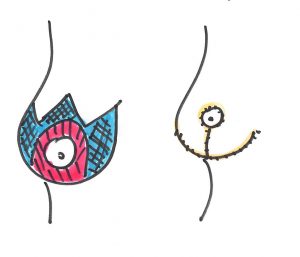 breast augmentation