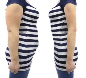 liposuction, Lubbock
